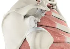 shoulder labrum reconstruction