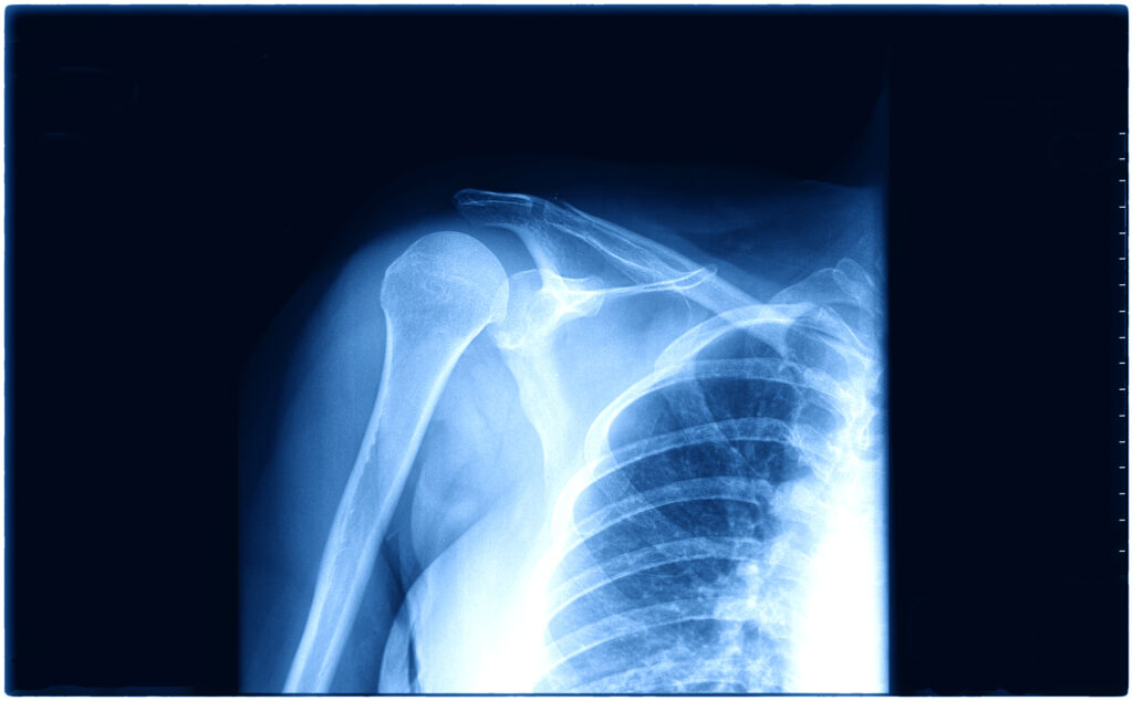 Shoulder X-Ray