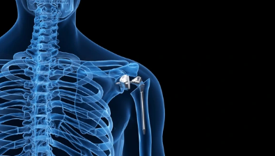 Reverse Shoulder Replacement