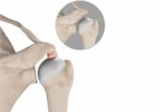 Subacromial Decompression