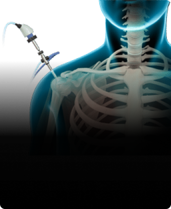How Long Does the Average Shoulder Replacement Last?
